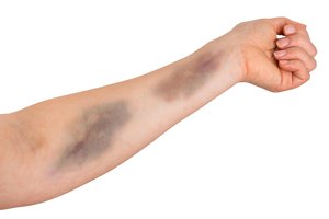 to bruise