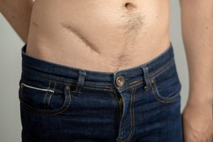 appendicitis