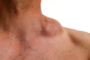 el tumor