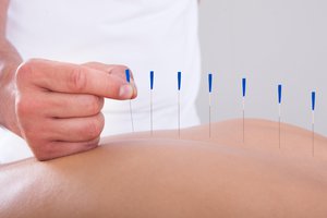 la acupuntura
