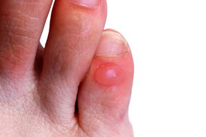 blister
