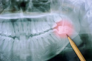 lower wisdom tooth