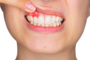 la gingivitis
