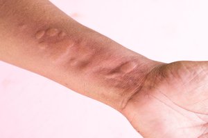 to get sores