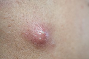 pimple