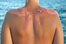 sunburned