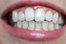 la dentadura
