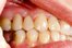 la caries