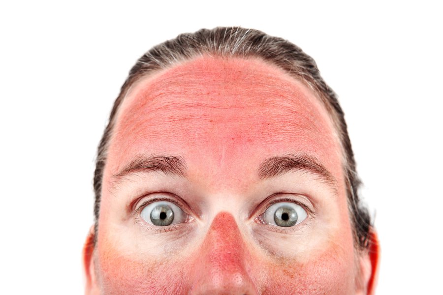 Sunburn | Traductor de inglés a español - inglés.com